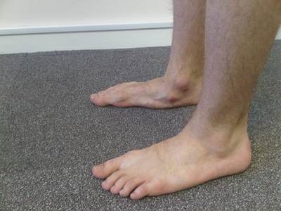 Misaligned feet and knees Treated on the Gold Coast