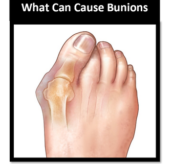 Podiatrist for bunions on the Gold Coast