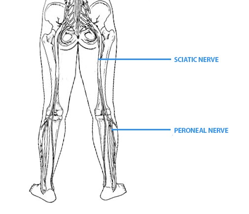 Sciatic Nerve Treatment Gold Coast